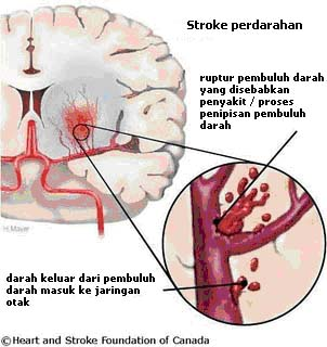 Illustration for article titled Obat Stroke
